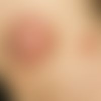 Primary cutaneous follicular center lymphoma: coarse, painless, solid tumor, clearly elevated abo...