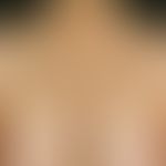 Primary cutaneous follicular center lymphoma: exanthematic sowing of reddish, smooth, shiny, to b...