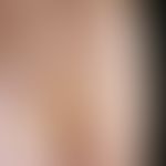 Primary cutaneous follicular center lymphoma: chronically active, increasing for 12 months, local...