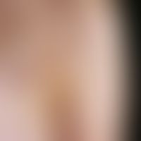 Primary cutaneous follicular center lymphoma: chronically active, increasing for 12 months, local...