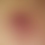 Lymphomatoid papulosis. not painful, ulcerated, moderately consistent papules of about 4 mm in di...