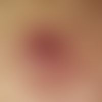 Lymphomatoid papulosis. not painful, ulcerated, moderately consistent papules of about 4 mm in di...
