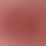 Lymphomatoid papulosis. reflected light microscopy: Advanced lymphomatoid papulosis has a centrol...