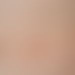 Lymphomatoid papulosis: A total of three acutely occurring red to reddish-brown, soft-elastic, pa...