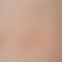 Lymphomatoid papulosis: A total of three acutely occurring red to reddish-brown, soft-elastic, pa...
