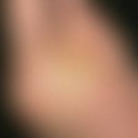 Malum perforans: Sharply defined, sparsely documented ulcer in the area of the sole of the foot i...
