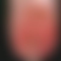 Malum perforans. considerably painful, 5x5 cm in diameter, clean ulcer of about 2 cm depth, at th...