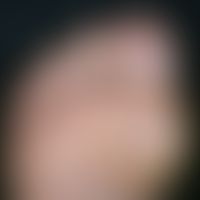 Malum perforans. sharply defined, painless ulcer at the ball of the big toe in a patient with dia...