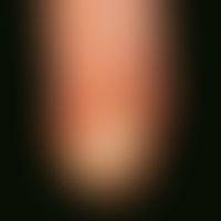 Malum perforans. Painless ulcer of the heel. Known and poorly controlled diabetes melitus. Polyne...