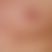 Mammilla, accessory. 0.6 cm high, solitary, brown plaque, clearly grown during puberty, localized...