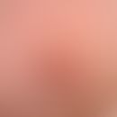 Chronic stationary, 2.5 cm large, sharply defined, clearly elevated, itchy, red, rough, scaly pla...