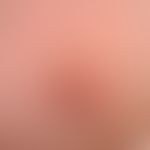 Chronic stationary, 2.5 cm large, sharply defined, clearly elevated, itchy, red, rough, scaly pla...