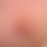 Chronic stationary, 2.5 cm large, sharply defined, clearly elevated, itchy, red, rough, scaly pla...