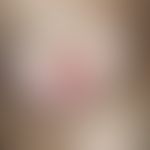 Nipple eczema. red, slightly scaly, sometimes weeping-crusted plaques in the area of both nipples...
