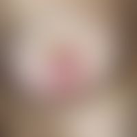 Nipple eczema. red, slightly scaly, sometimes weeping-crusted plaques in the area of both nipples...