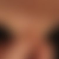 Marfan Syndrom: leicht überdehnbare Haut.&nbsp;
