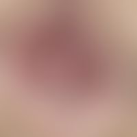 Mariscs. Multiple, chronically stationary, indolent, skin-coloured, soft, smooth knots that do no...