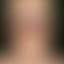 Masern. Fieber bis 40 °C, Rhinitis, Konjunktivitis, Lichtscheu, Pharyngitis. Am 3.-4. Krankheitst...