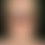 Measles. fever up to 40 °C, rhinitis, conjunctivitis, photophobia, pharyngitis. on the 3rd-4th da...
