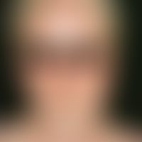 Masern. Fieber bis 40 °C, Rhinitis, Konjunktivitis, Lichtscheu, Pharyngitis. Am 3.-4. Krankheitst...