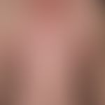 Measles: Generalized, disseminated, partly confluent, pale red spots on the thorax of a 39-year-o...