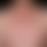 Survey picture ofthe upper thorax: Exanthematic stage: Generalized, disseminated, partly confluen...