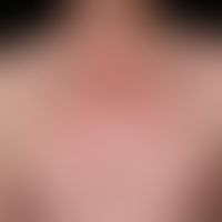 Masern. Übersichtsaufnahme oberer Thorax: Exanthematisches Stadium: Generalisierte, disseminierte...