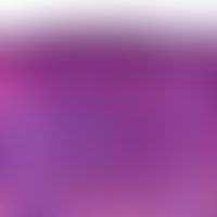 Mastocytoma, cutaneous. the surface epithelium is unchanged. the entire dermis is pervaded by a d...