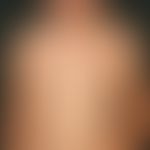 Mastocytosis. type: Multiple mastocytomas Multiple, chronically stationary, approx. 0.6 x 0.7 cm ...