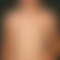 Mastocytosis. type: Multiple mastocytomas Multiple, chronically stationary, approx. 0.6 x 0.7 cm ...