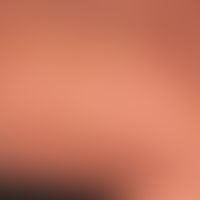 Mastozytose. Kutane, diffuse&nbsp;Mastozytose mit flächiger "peau d`orange". Sehr seltenes Krankh...