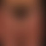 Mastocytosis (type Urticaria pigmentosa): pronounced cutaneous mastocytosis of the urticaria pigm...