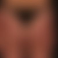 Mastozytose (Typ Urticaria pigmentosa):&nbsp;ausgeprägte kutane Mastozytose vom Typ der Urticaria...