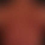 Mastocytosis of the urticaria pigmentosa type: generalized infestation of the integument with dis...
