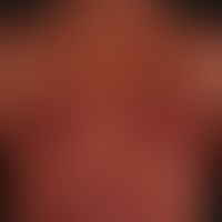 Mastozytose&nbsp;vom Typ der&nbsp;Urticaria pigmentosa: generalisierter (nahezu erythrodermischer...