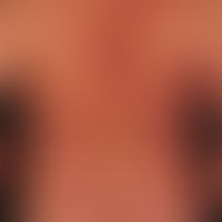 Mastocytosis of the urticaria pigmentosa type: generalised infestation of the integument with dis...