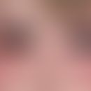 Angioödem:&nbsp;erstmals aufgetretene, seit mehreren Stunden bestehende, zunächst linksseitige, s...