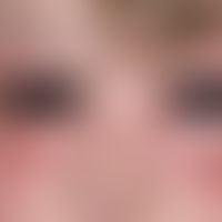 Angioedema: First occurred swelling of the eyelids in a 42-year-old woman which has been present ...