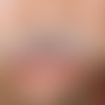 Angioödem:&nbsp;innerhalb weniger Minuten aufgetretene Schwellung der Unterlippe und der re. Hand...