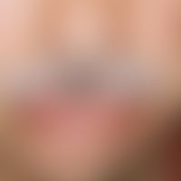 Angioödem:&nbsp;innerhalb weniger Minuten aufgetretene Schwellung der Unterlippe und der re. Hand...