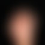 Angioödem: akutes, transientes Auftreten von diffusen, blassen, gering juckenden, teigig-ödematös...