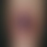 Drug reaction, fixed: unusual image of a 3.5 x 2.5 cm measuring, crusty covered, flat ulcer on th...