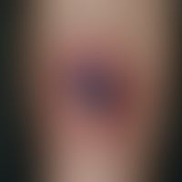 Drug reaction, fixed: unusual image of a 3.5 x 2.5 cm measuring, crusty covered, flat ulcer on th...