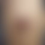 Drug reaction, fixed. 3-day-old, roundish, sharply defined, reddish-brown plaque on the lower leg...