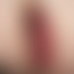 Drug reaction, fixed: solitary or limited to a few lesions, usually round to oval, deep red, late...