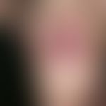 Drug reaction, fixed: acute, solitary, red, sharply defined, moderately itchy plaque which has be...