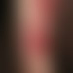 Drug reaction, fixed. multiple, 2.0-12.0 cm large, round or oval, initially deep red, later brown...