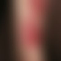 Drug reaction, fixed. multiple, 2.0-12.0 cm large, round or oval, initially deep red, later brown...