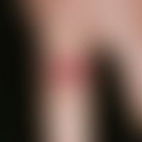 Medicinal reaction, fixed. acute, solitary, 1.0 cm large, round to oval, initially deep red, late...