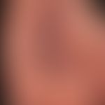 Drug reaction, fixed: recurrent course with acute itchy redness 1 day after taking ibuprofen (600...